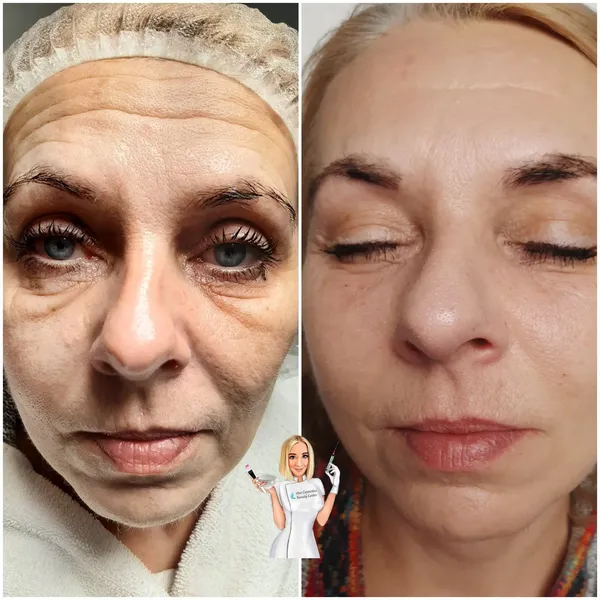 Efekt zabiegu przed i po