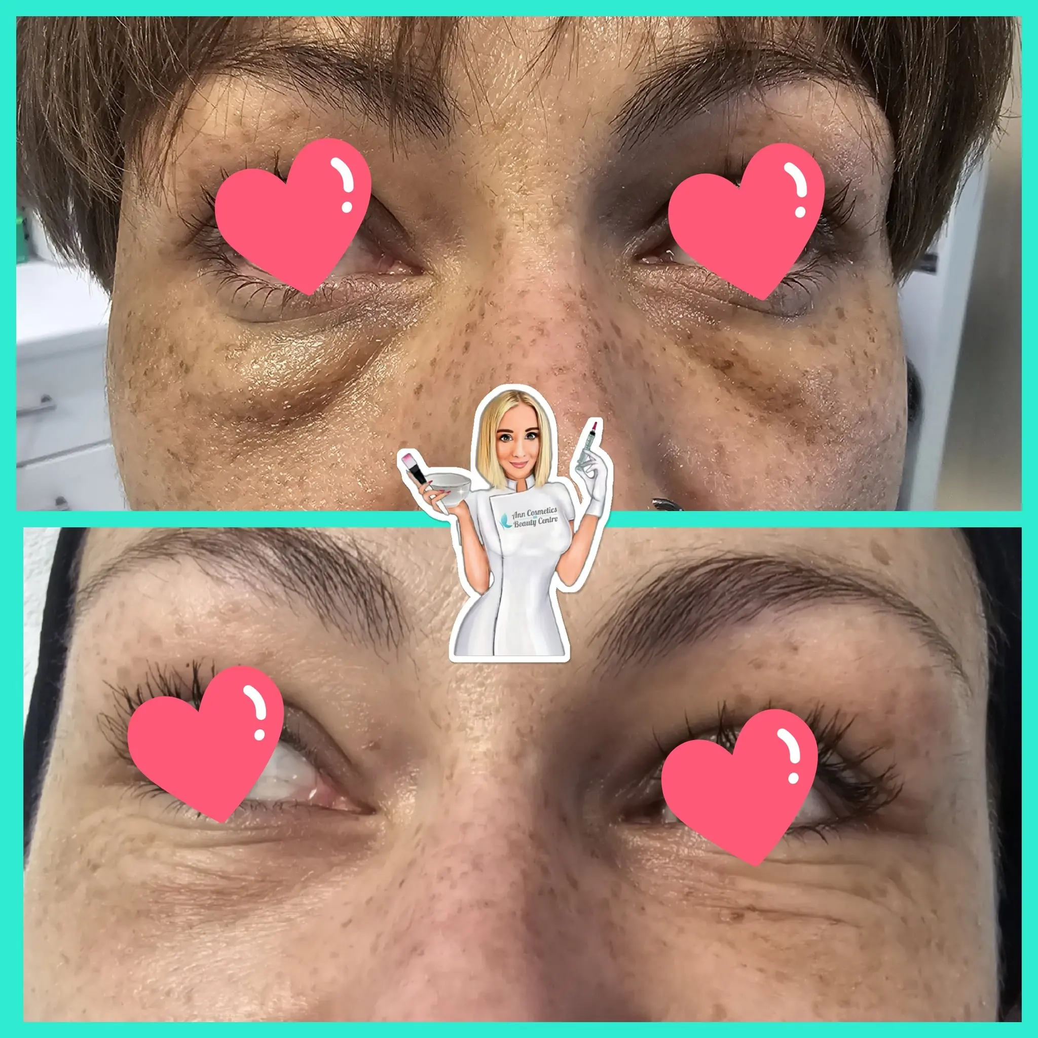 Efekt zabiegu przed i po