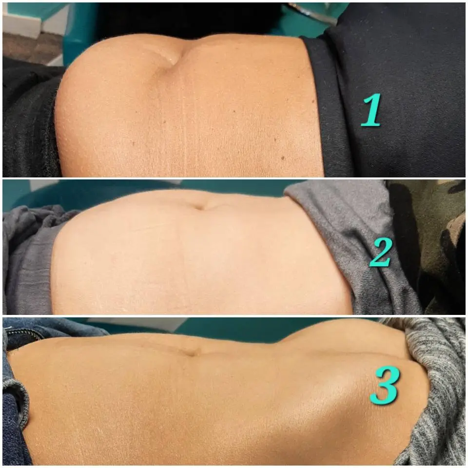 Efekt zabiegu przed i po