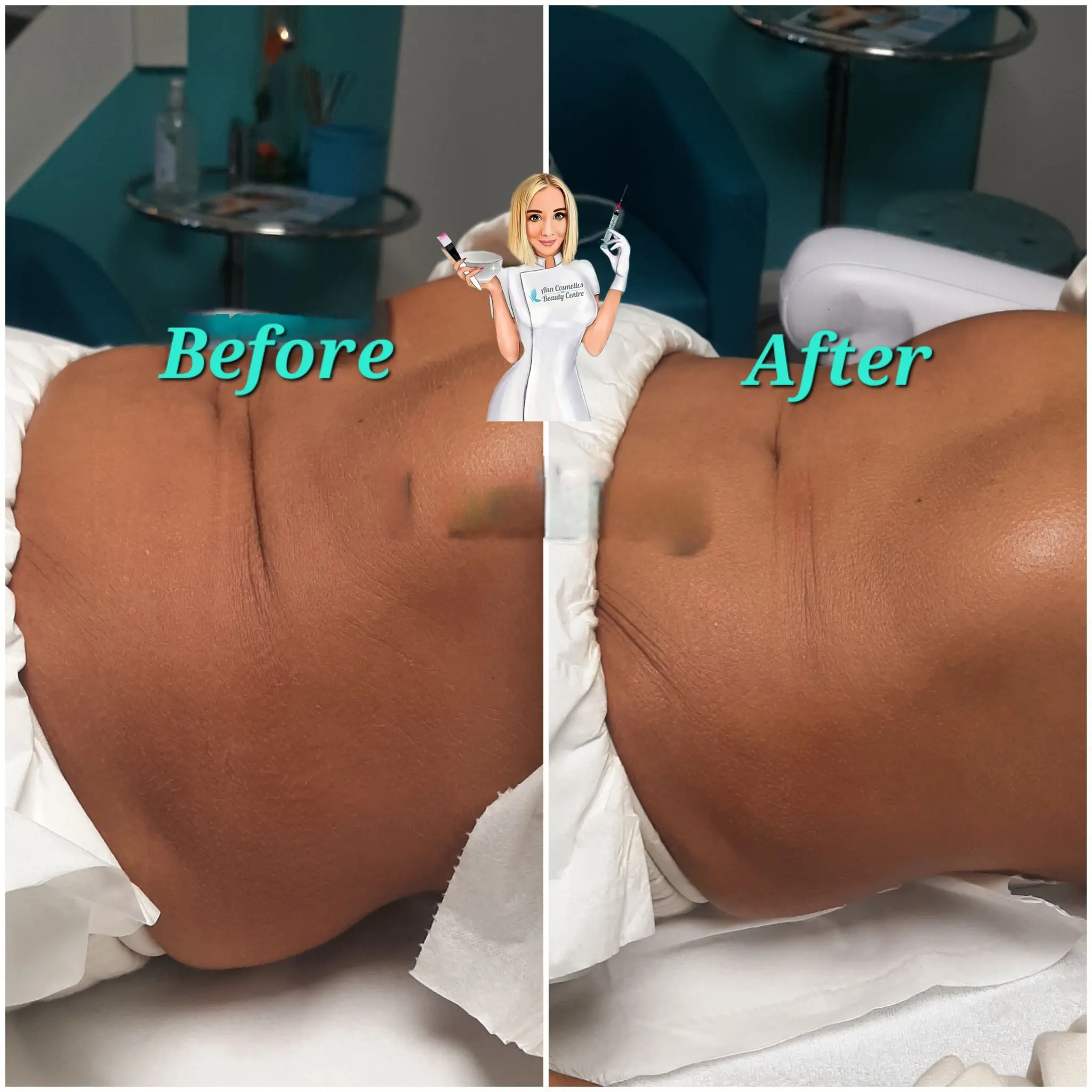 Efekt zabiegu przed i po