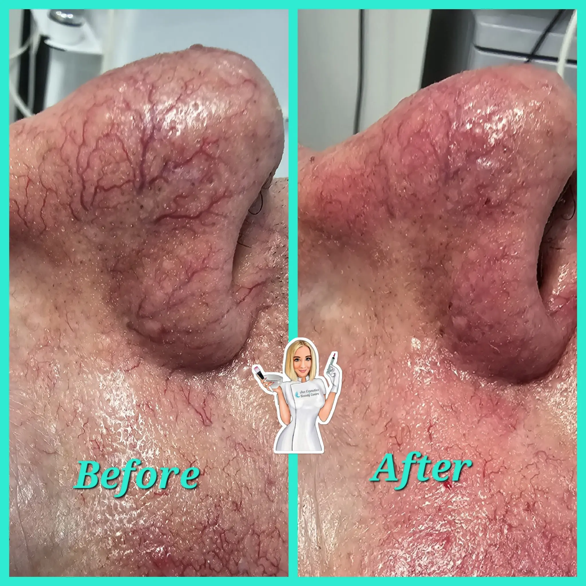 Efekt zabiegu przed i po